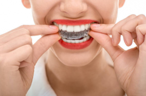 Duluth Family Dental - Dental Veneers